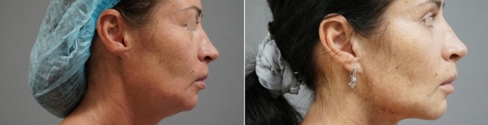 Пациентка доктора Пенаева до и после мультитехнологичного малоинвазивного лифтинга лица