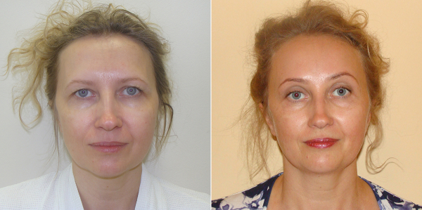 До и после эндоскопической подтяжки лба