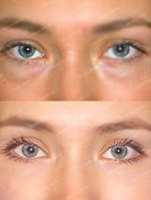 do i posle blefaroplastiki