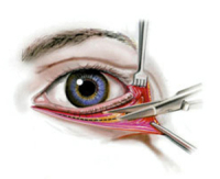 blefaroplastika