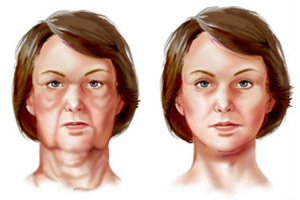 Подтяжка шеи и лица, Светлана Пшонкина