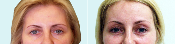 До и после эндоскопической подтяжки лба