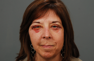 Осложнения после пластики век