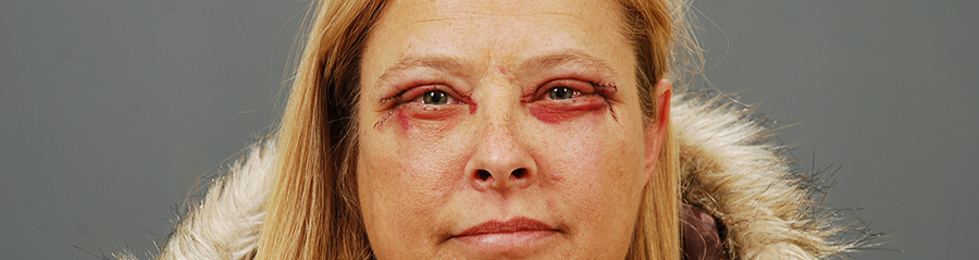 Осложнения после блефаропластики