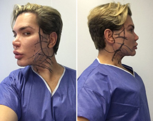 Родриго Алвес, известный всему миру как «Живой Кен», сделал очередную пластику лица