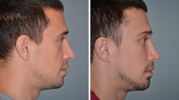 Эндоскопическое омоложение у пластического хирурга Дениса Агапова