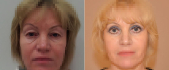 Ольга Ованесова. Пациентка до и после блефаропластики