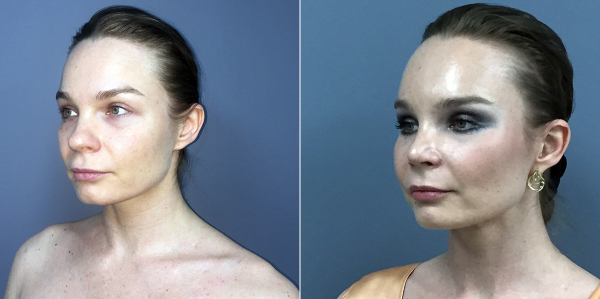 Ринопластика и подтяжка лица