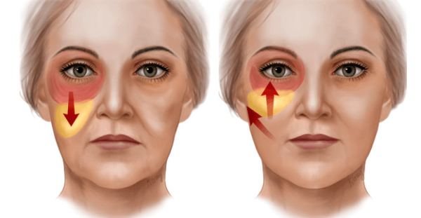 Чек-лифтинг