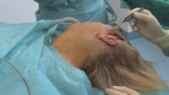 Пластическая хирургия против птоза