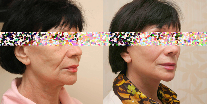 Александр Жуков подтяжка лица