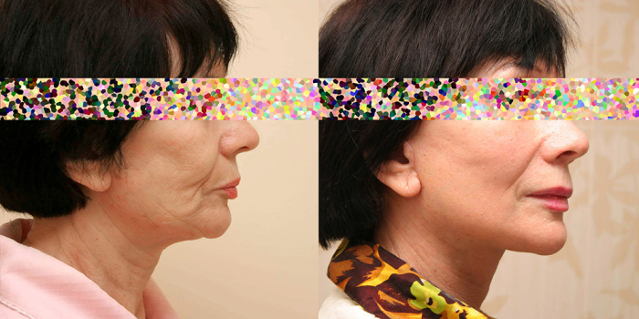 Александр Жуков подтяжка лица