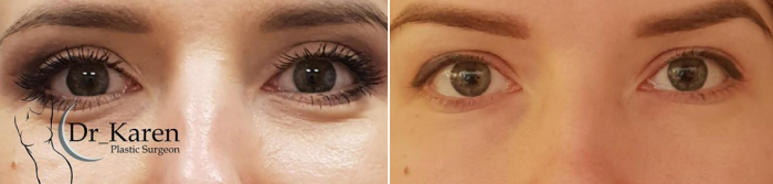 Блефаропластика до и после