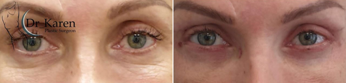 Пациентка доктора Пайтяна до и после блефаропластики