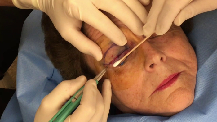 Блефаропластика под местной анестезией