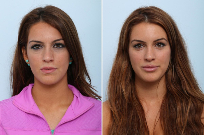 Пример увеличения губ филлерами