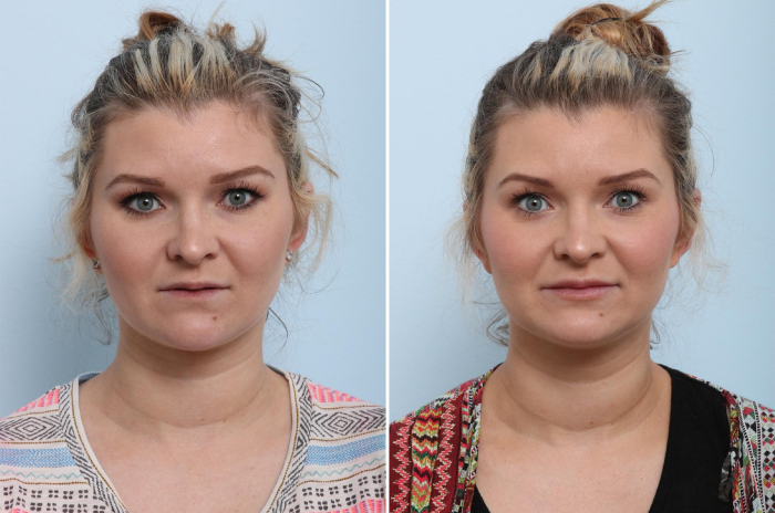 Пример увеличения губ филлерами