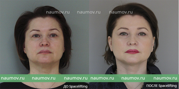 спейслифтинг Владимир Наумов