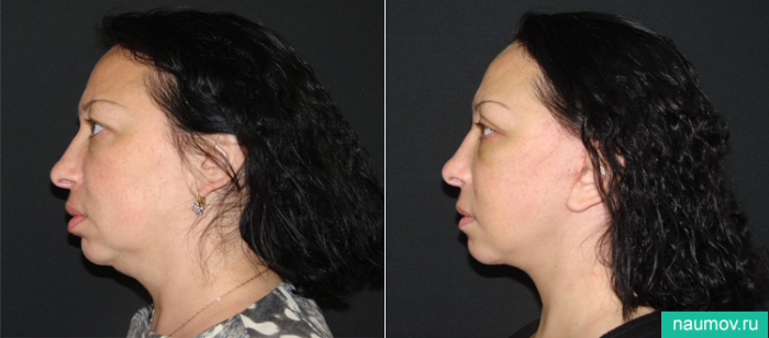 Лифтинг Мендельсона Владимир Наумов