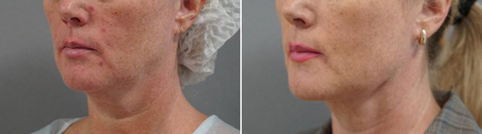 Арслан Пенаев подтяжка лица