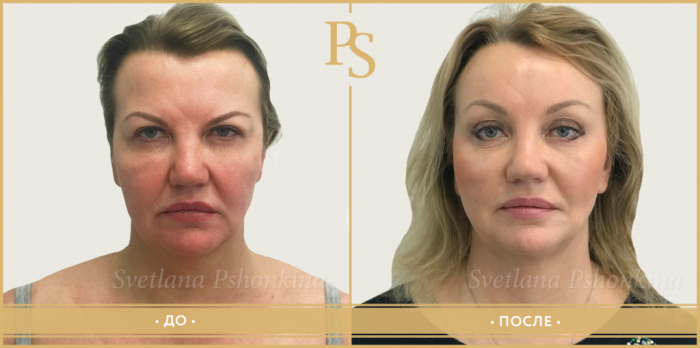 Пациентка пластического хирурга Светланы Пшонкиной до и после омоложения лица по авторской методике Визаж-лифт