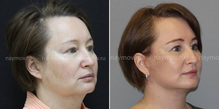 Лифтинг Мендельсона Наумов