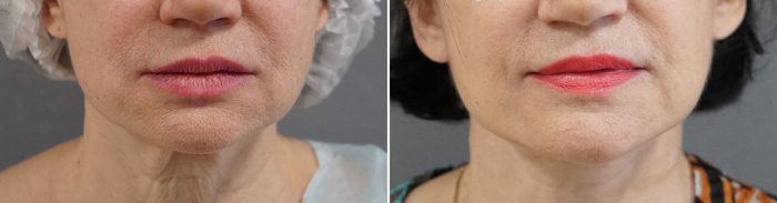 Подтяжка лица Арслан Пенаев