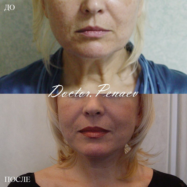 Пациентка доктора Пенаева до и после ультразвукового СМАС-лифтинга