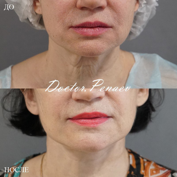 Пациентка доктора Пенаева до и после ультразвукового СМАС-лифтинга