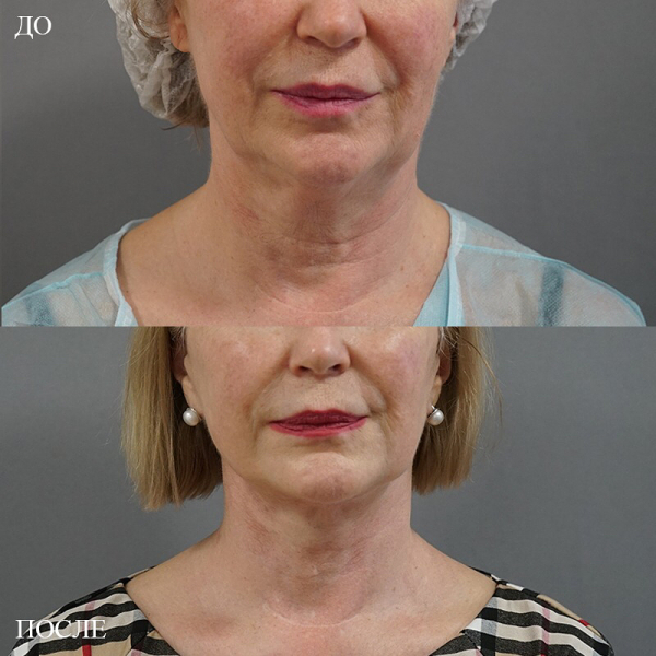 Пациентка доктора Пенаева после Ultrasound SMAS lifting