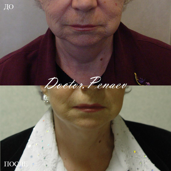Пациентка доктора Пенаева до и после ультразвуковой СМАС-подтяжки