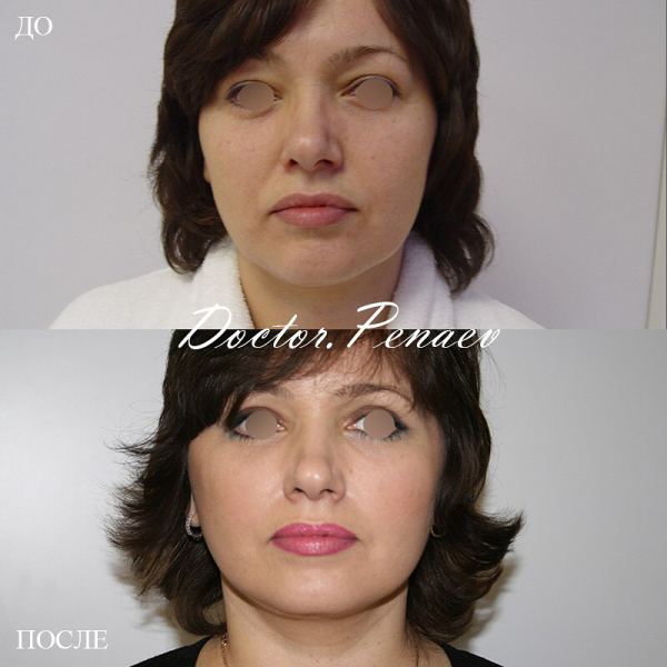 Пациентка доктора Пенаева до и после ультразвукового СМАС-лифтинга лица