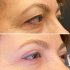 Верхняя блефаропластика, Карен Пайтян