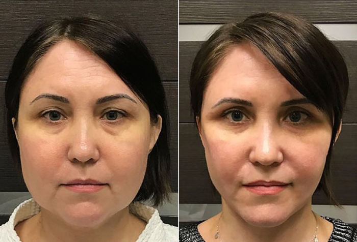 омоложение лица Ольга Ованесова