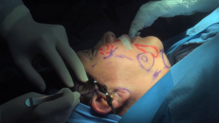 Реабилитация после подтяжки лица