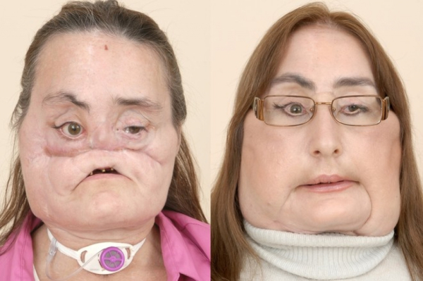 Этапы восстановления Конни Калп