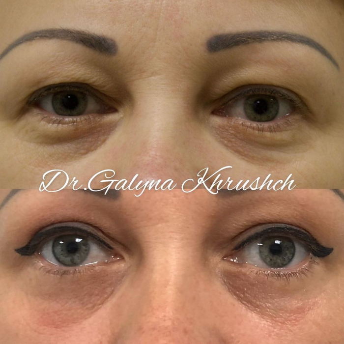 Галина Хрущ блефаропластика