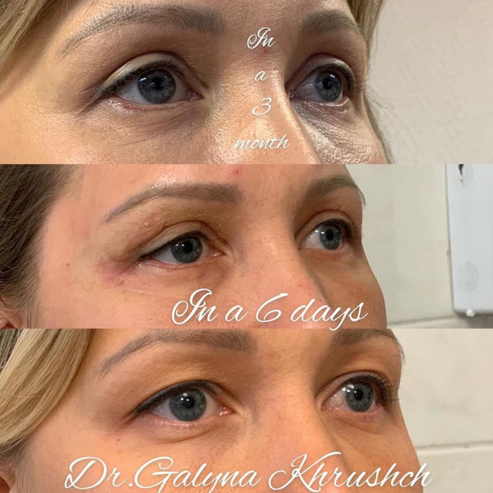 Галина Хрущ блефаропластика