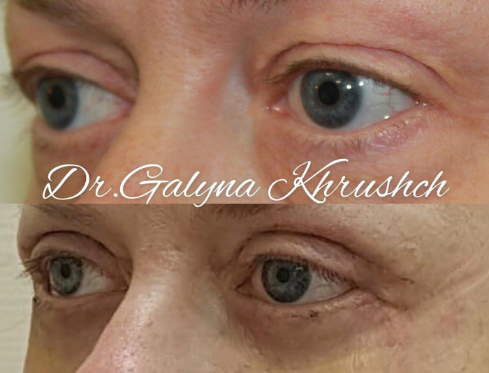 Галина Хрущ блефаропластика