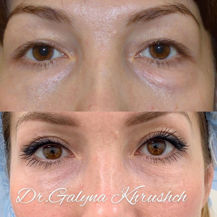 Галина Хрущ блефаропластика