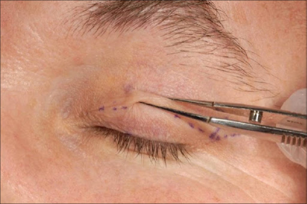 Блефаропластика как омолаживающая операция