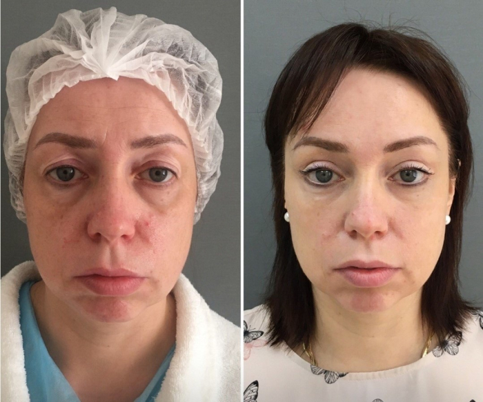 Пациентка доктора Марины Четвериковой до и после комплексной операции по омоложению лица