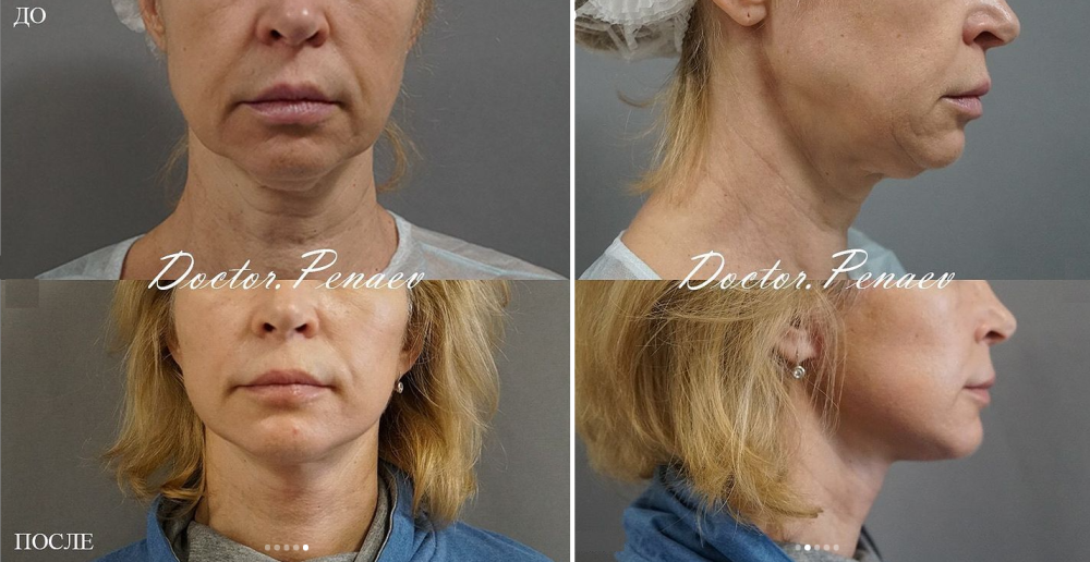 Пациентка пластического хирурга Арслана Пенаева до и после SMAS-подтяжки лица с ультразвуковой диссекцией тканей.