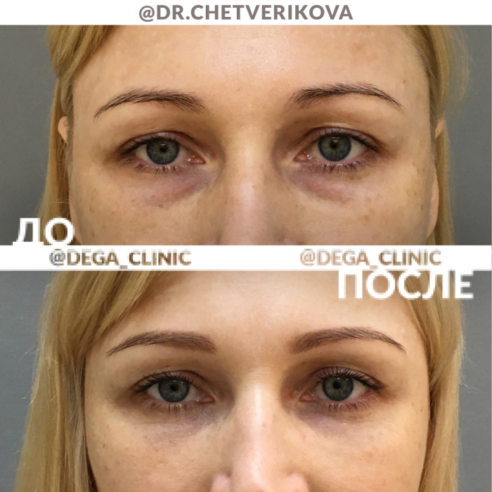 Пациентка доктора Марины Четвериковой до и после блефаропластики