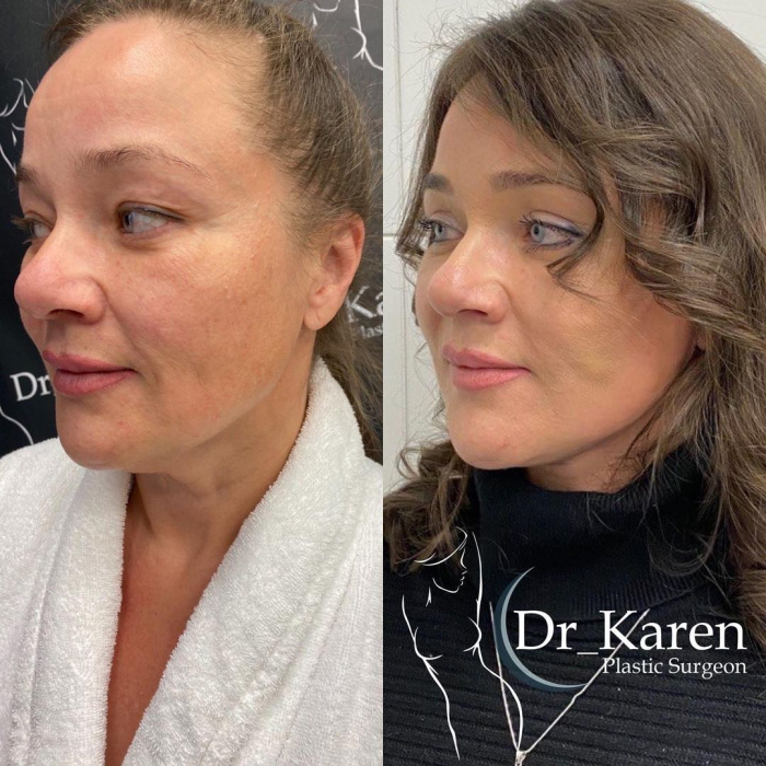 Пациентка пластического хирурга Карена Пайтяна до и после СМАС-лифтинга лица