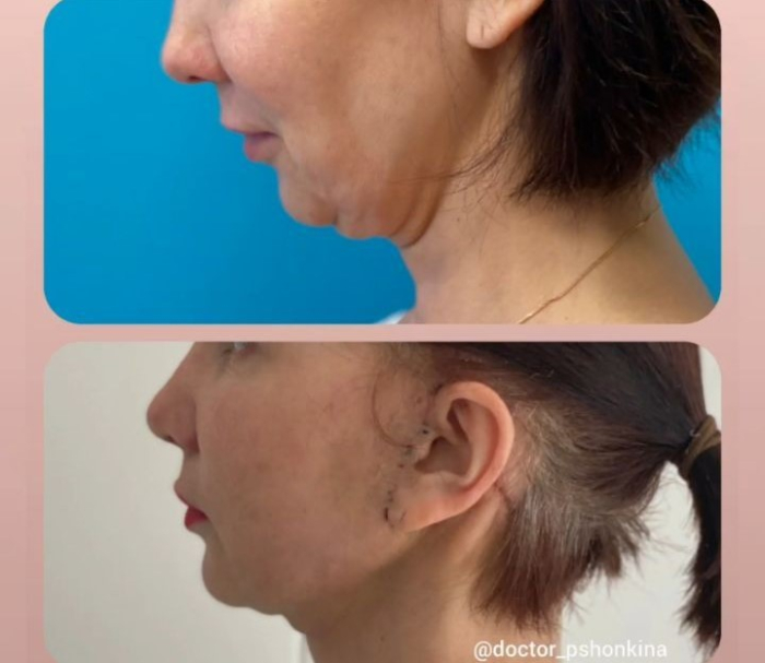 подтяжка лица у Пшонкиной