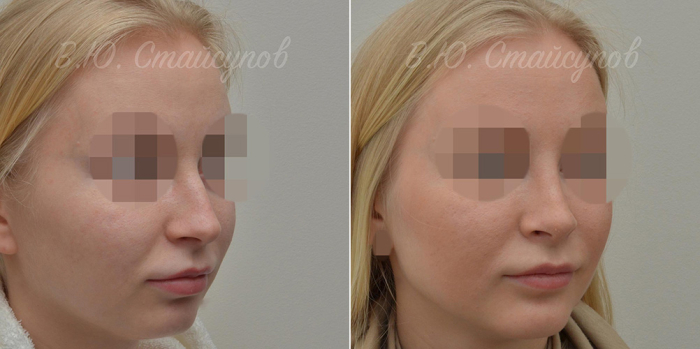 Валерий Стайсупов пластика подбородка