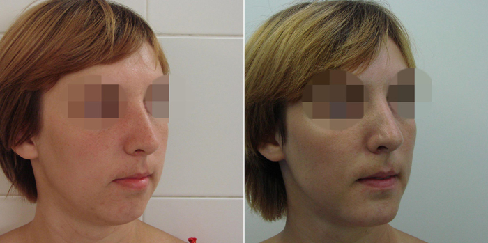 4 Пациентка доктора Стайсупова до и после коррекции подбородка