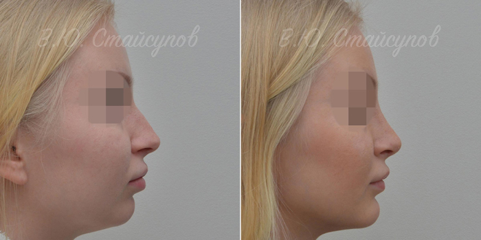 Валерий Стайсупов пластика подбородка