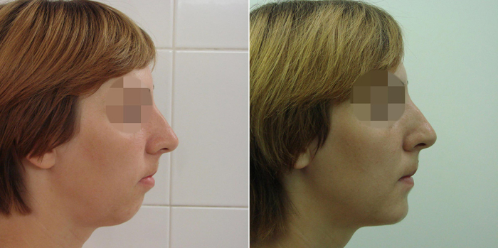 4 Пациентка доктора Стайсупова до и после коррекции подбородка